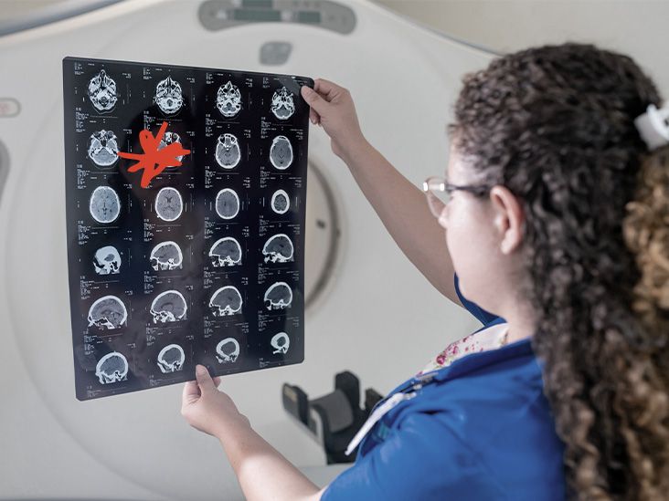 גישת אולטרסאונד יכולה להעביר את התרופה לאלצהיימר ישירות למוח