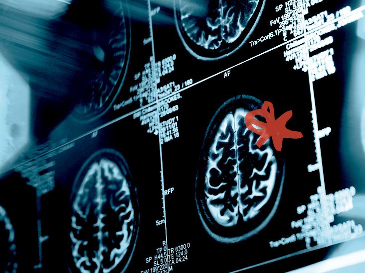 כיצד בינה מלאכותית עשויה לסייע באבחון ילדים עם ADHD