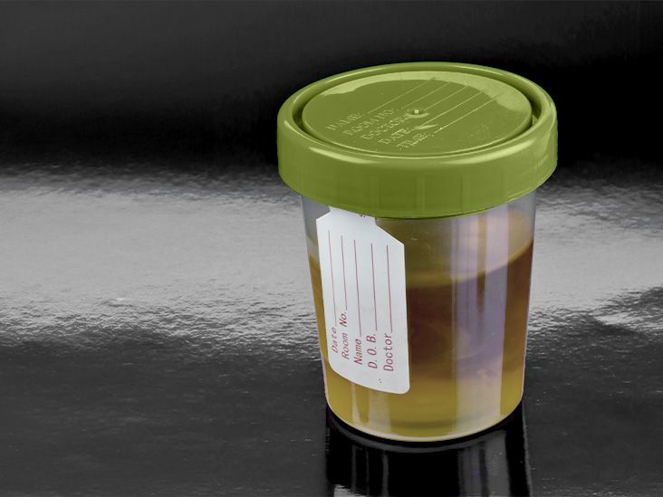 בדיקת שתן חדשה עשויה להיות מסוגלת לזהות סרטן השחלות מוקדם