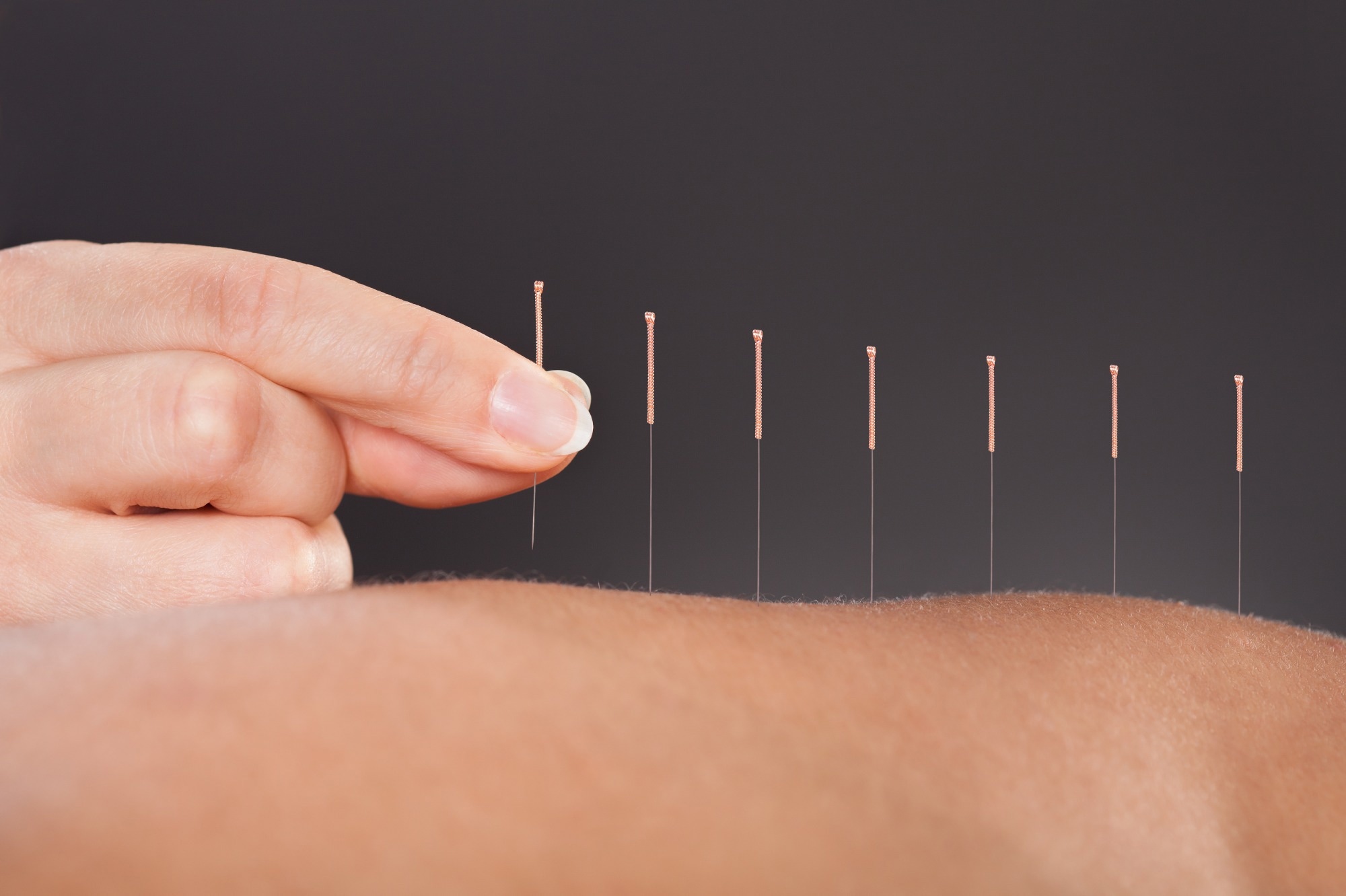 Study: Effect of acupuncture on ischaemic stroke in patients with rheumatoid arthritis: a nationwide propensity scorematched study. Image Credit: Andrey_Popov/Shutterstock.com