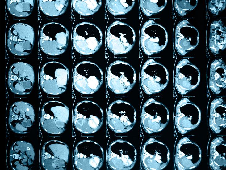 השמנת יתר עלולה להשפיע על תהליכים מטבוליים ותפקודי כבד, כך עולה ממחקר