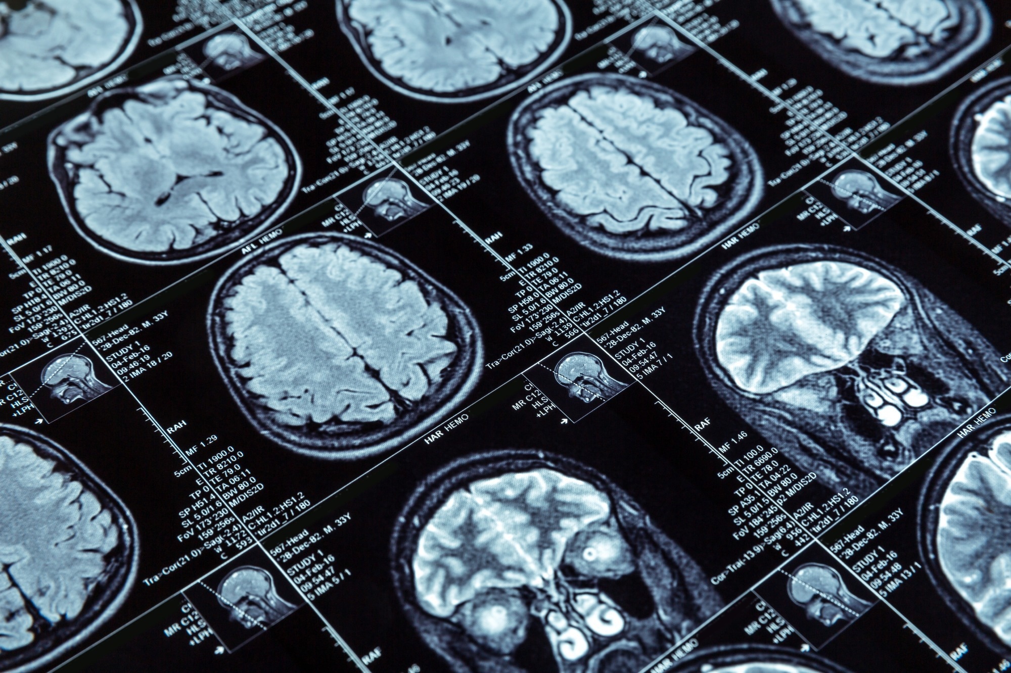 Study: Using brain structural neuroimaging measures to predict psychosis onset for individuals at clinical high-risk. Image Credit: Nomad_Soul/Shutterstock.com