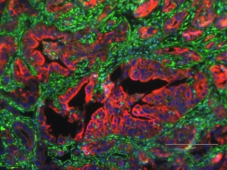 מחקר מצביע על חלבון הקשור לסרטן לבלב גרורתי