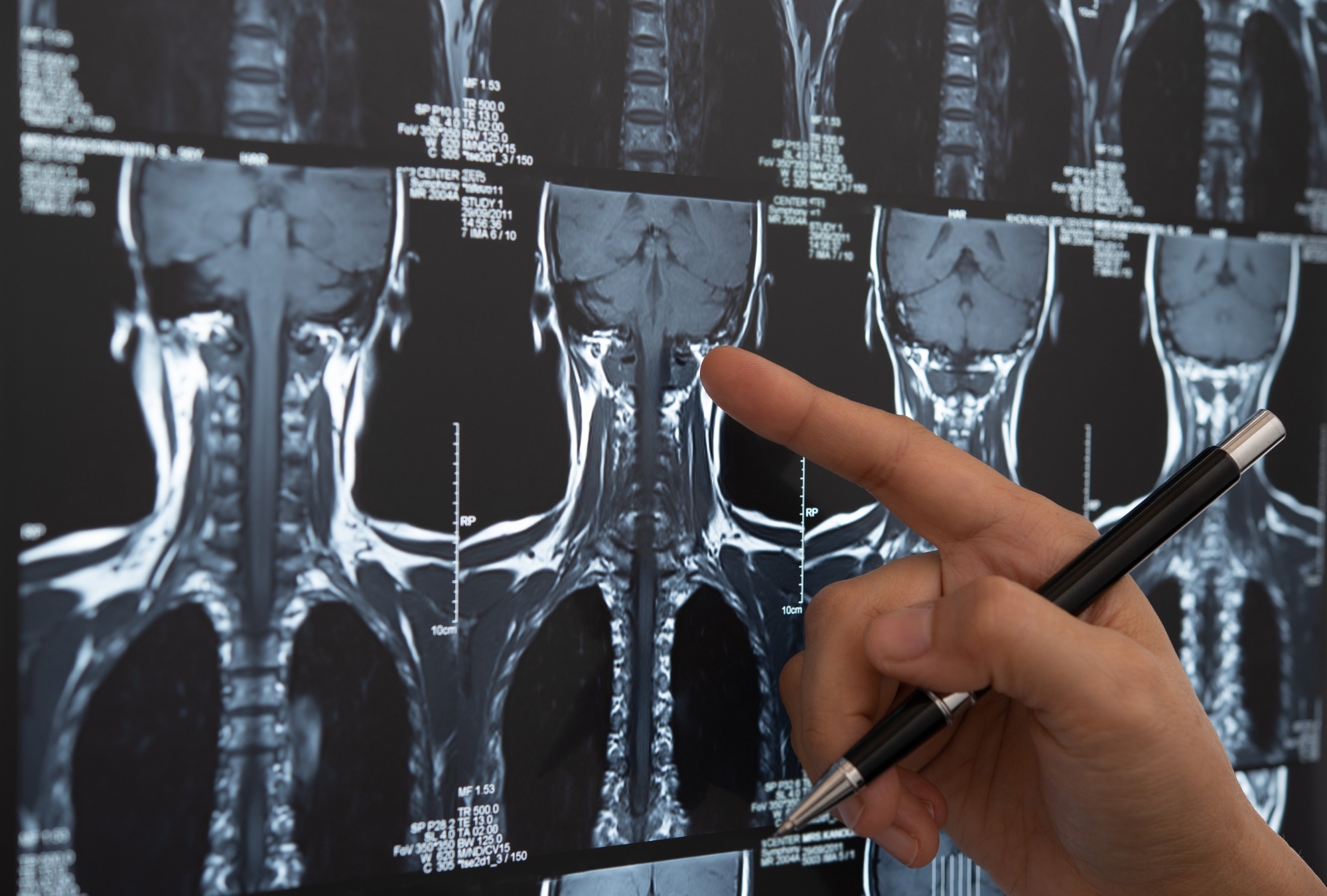 עישון, שתייה והרגלי תזונה הקשורים לסיכון לסרטן הראש והצוואר, מגלה מחקר