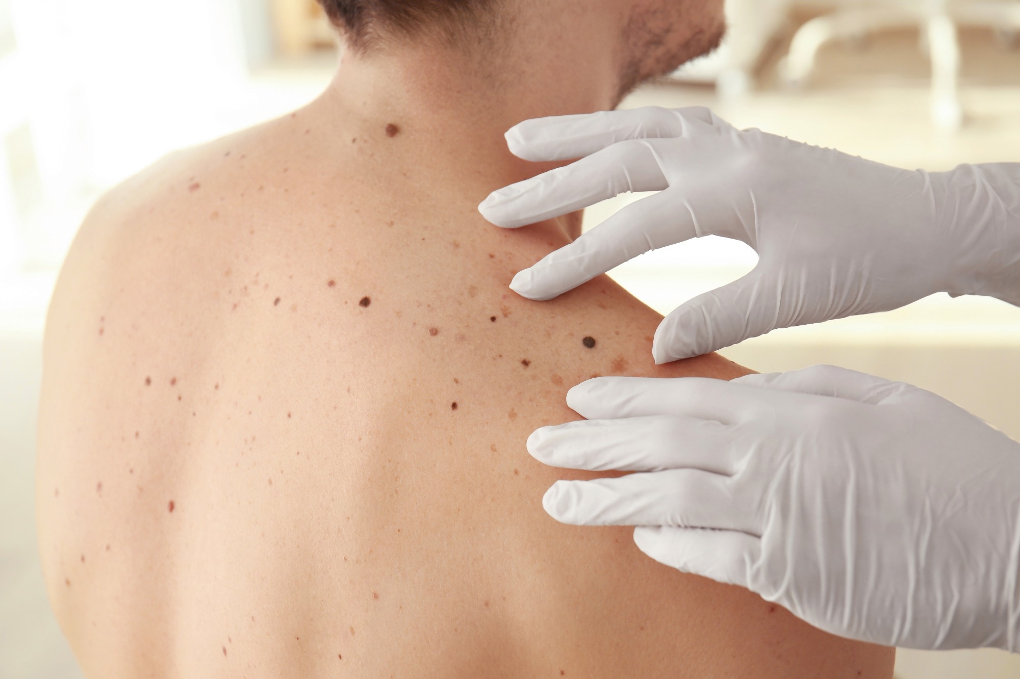 Study: Improving survival in advanced melanoma patients: a trend analysis from 2013 to 2021. Image Credit: Africa Studio/Shutterstock.com