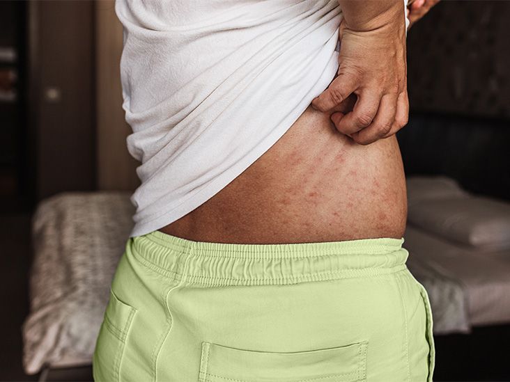 כיצד מחקר אקזמה על חיידקי עור עשוי להוביל לטיפול בגירוד