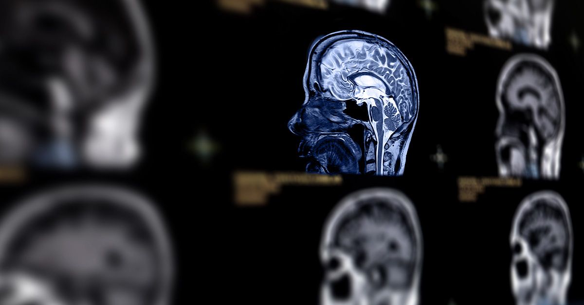 השמנת יתר ודיאטה עתירת שומן עלולים להאיץ את הזדקנות המוח, להוביל לירידה קוגניטיבית