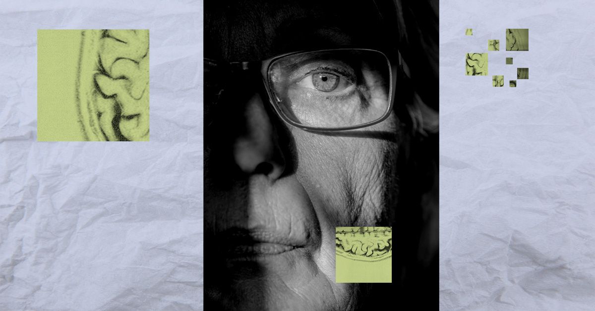 וריאנט גנטי שזוהה לאחרונה עשוי להגן מפני אלצהיימר