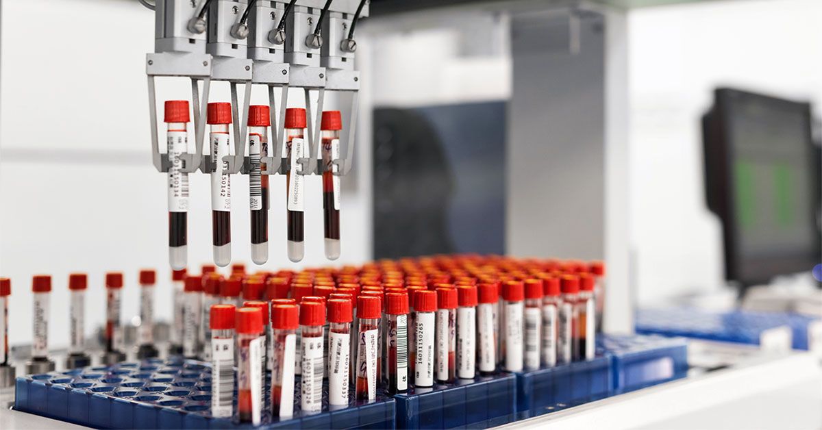 סימנים של טרשת נפוצה עשויים להיות גלויים בדם שנים לפני ההתלקחות הראשונה של התסמינים