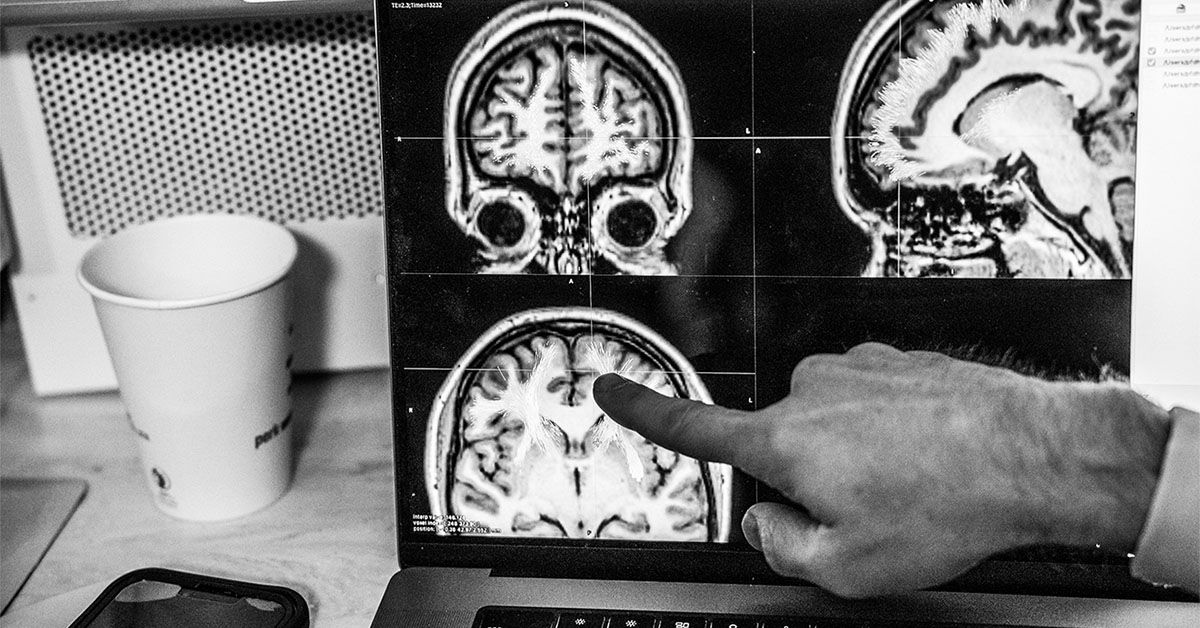 הזדקנות החומר הלבן במוח עשויה להשפיע על התאוששות משבץ, כך עולה ממחקר