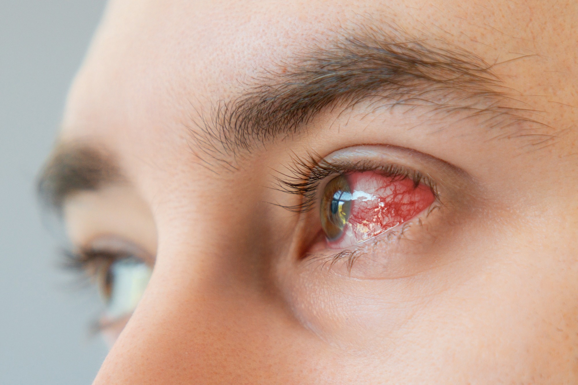 Study: Harmol used for the treatment of herpes simplex virus induced keratitis. Image Credit: STEKLO/Shutterstock.com