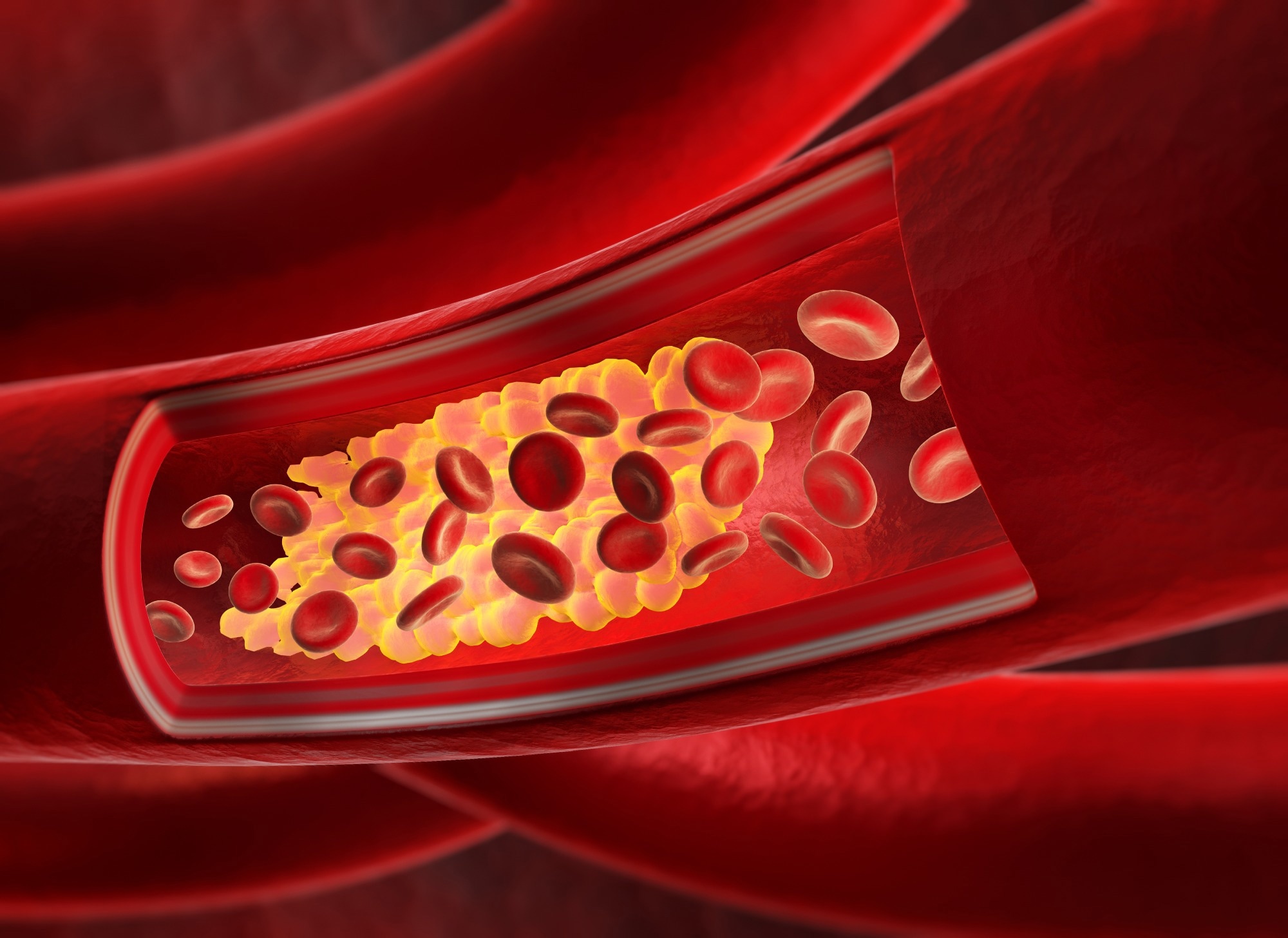 חומר הפרעות RNA plozasiran מכוון ל-APOC3 לטיפול יעיל בעור שומנים בדם