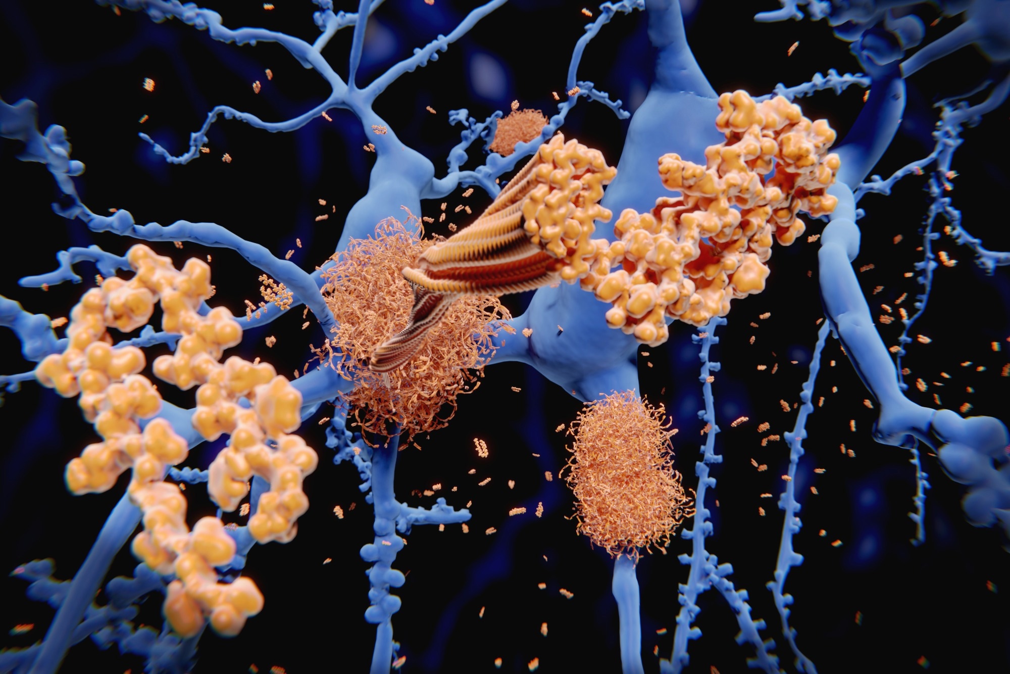 Study: Regulation of cell distancing in peri-plaque glial nets by Plexin-B1 affects glial activation and amyloid compaction in Alzheimer’s disease. Image Credit: Juan Gaertner / Shutterstock