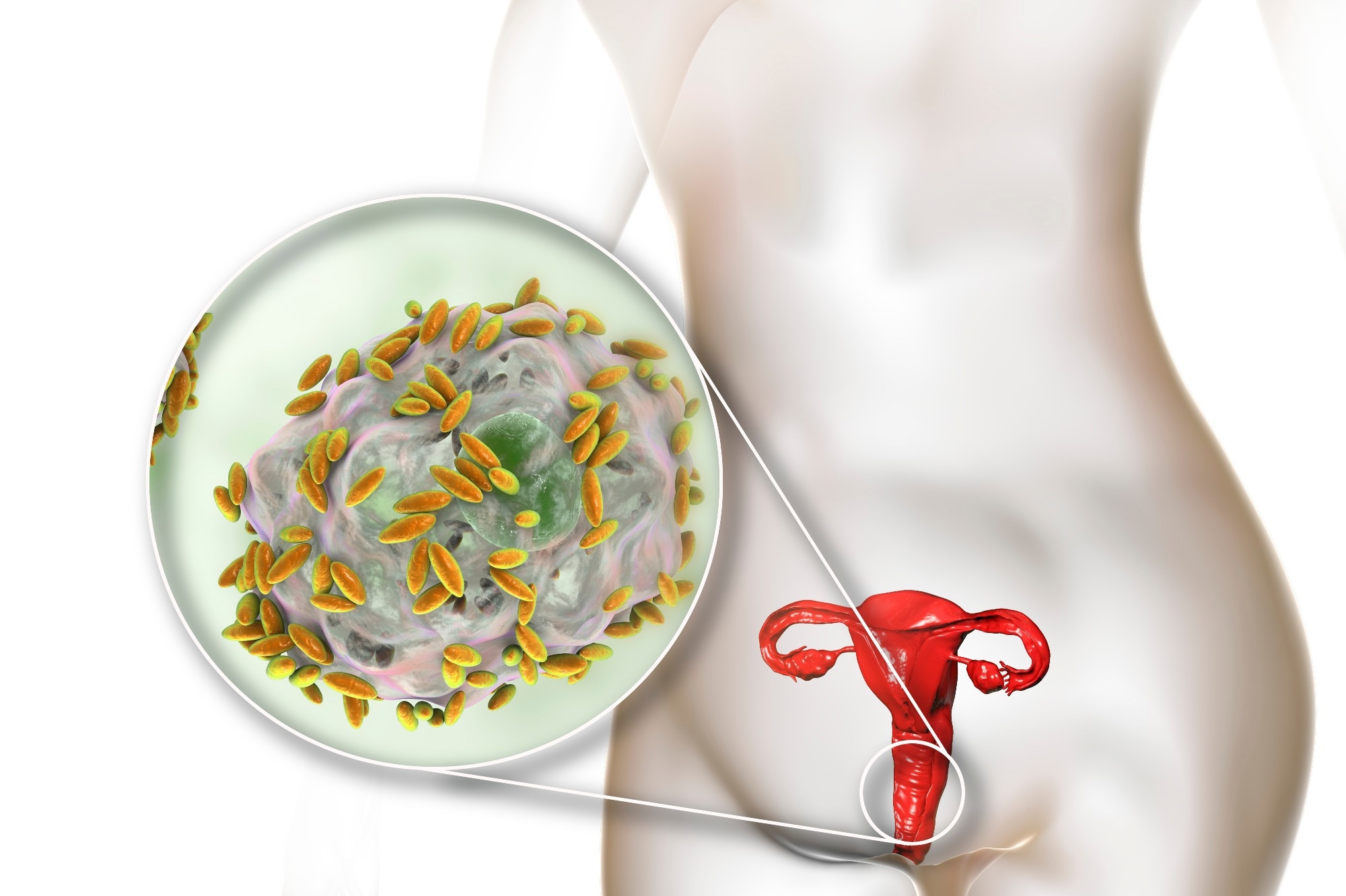 מחקר קושר מיני גרדנרלה מגוונים בנשים הרות לסיכון גבוה יותר ללידה מוקדמת