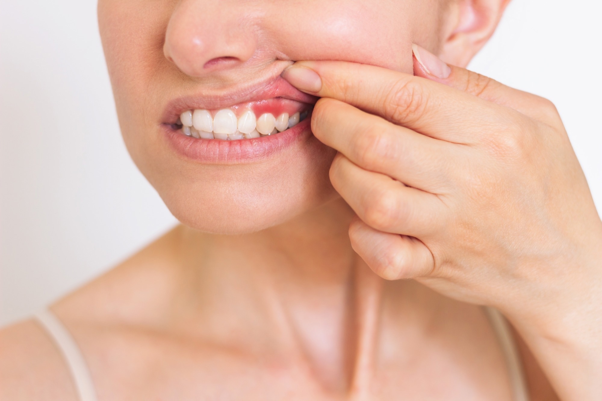​​​​​​​Study: Periodontitis, Dental Procedures, and Young-Onset Cryptogenic Stroke. Image Credit: Olga by Shefer/Shutterstock.com