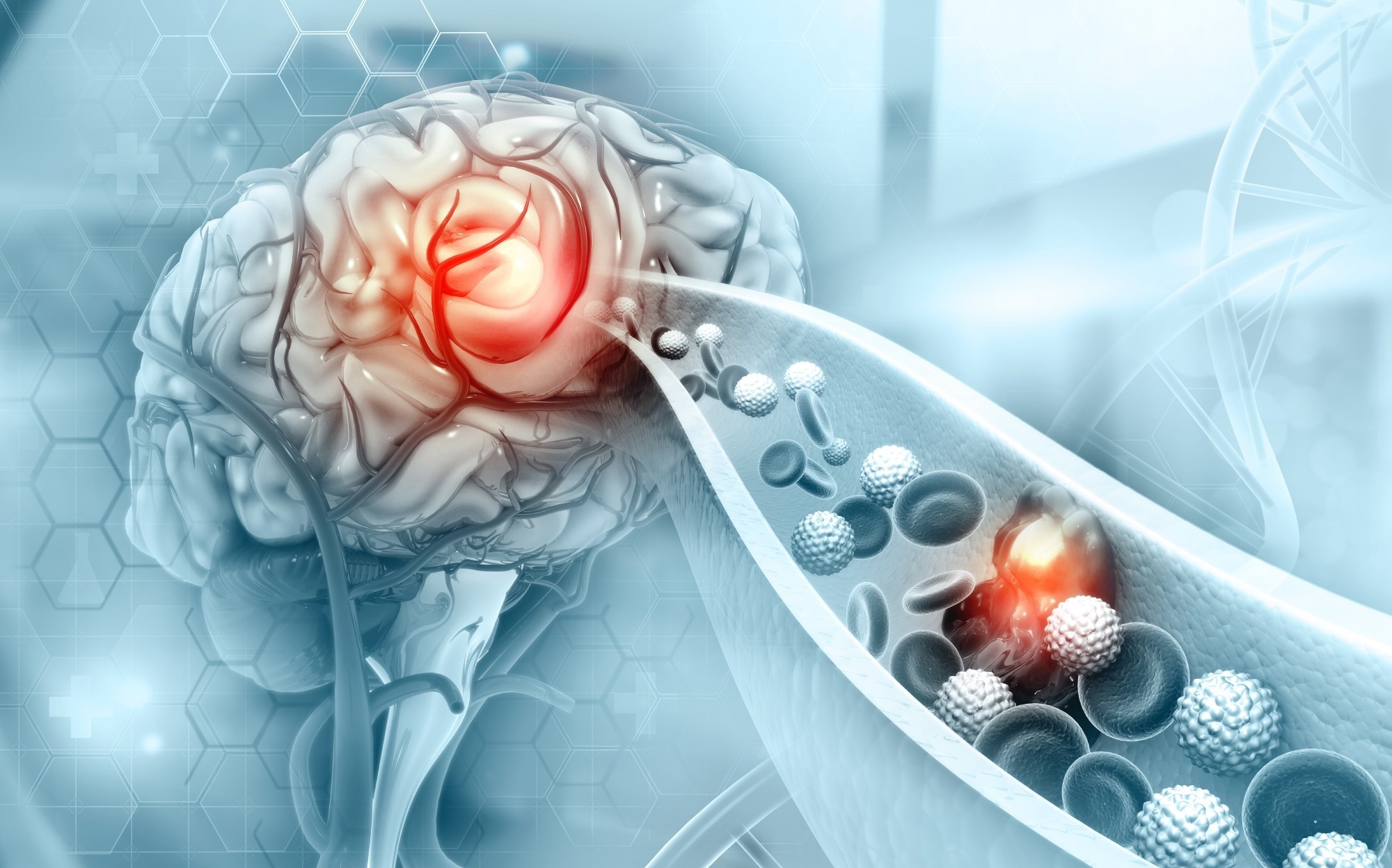 Study: Overweight in adolescence and young adulthood in association with adult cerebrovascular disease: the NFBC1966 study. Image Credit: crystal light / Shutterstock.com