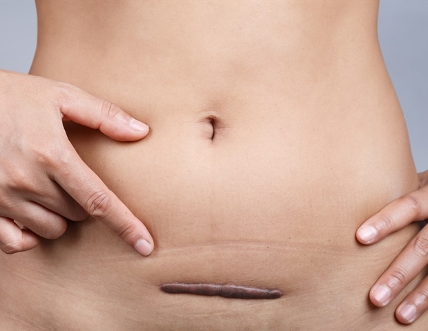 הסקר מגלה נשים רבות שאינן מודעות לטיפולי שרירנים ברחם זעיר פולשניים