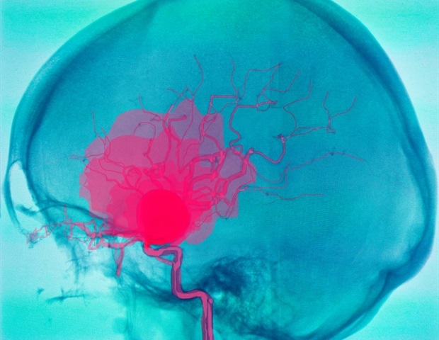 חקור מצבי GI הקשורים להתפתחות מפרצת תוך גולגולתית ולקרע