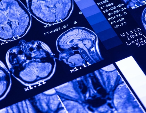 חומצות שומן אומגה 3 מראות פוטנציאל בהגנה על בריאות המוח אצל מבוגרים