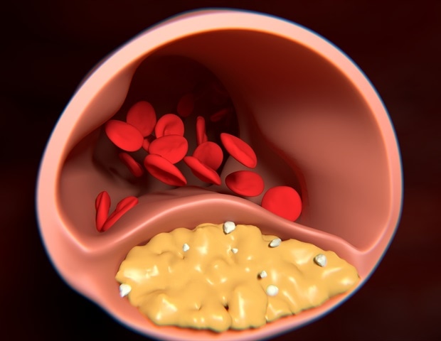 גילוי מוקדם של מחלות לב וכלי דם באמצעות למידת מכונה מתקדמת