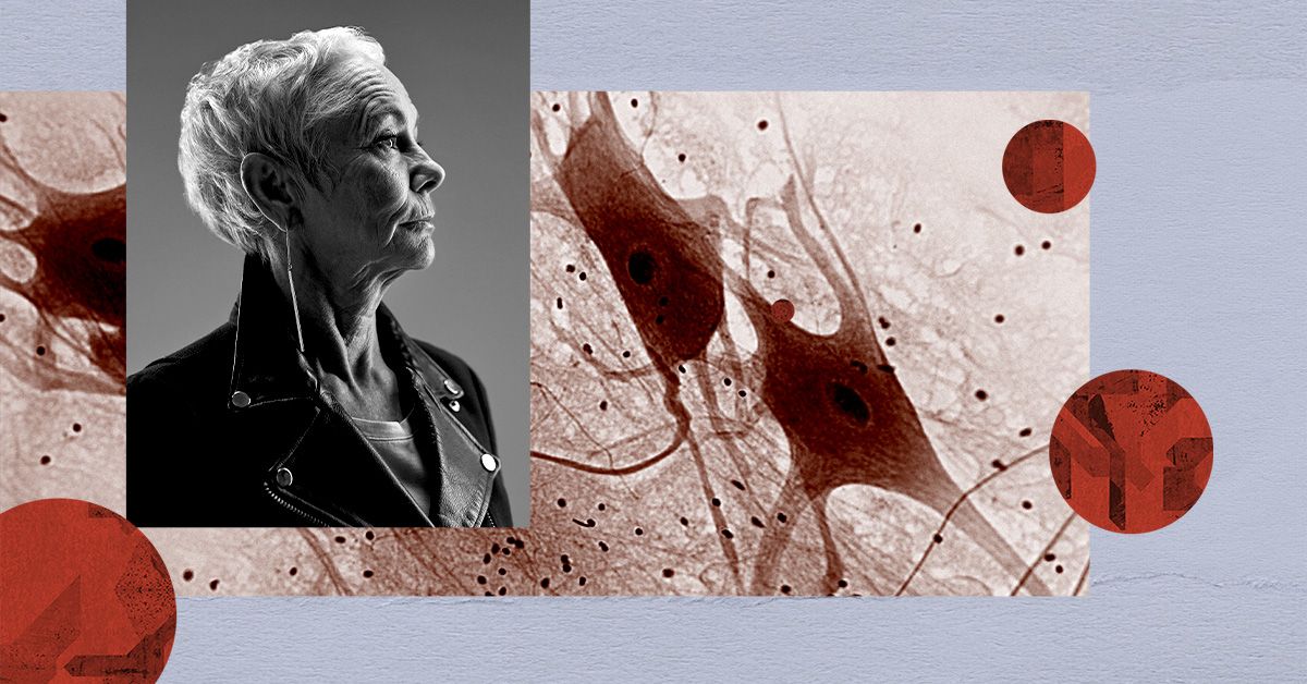 ניהול כולסטרול עשוי לסייע בהורדת הסיכון לאלצהיימר, מחלת פרקינסון