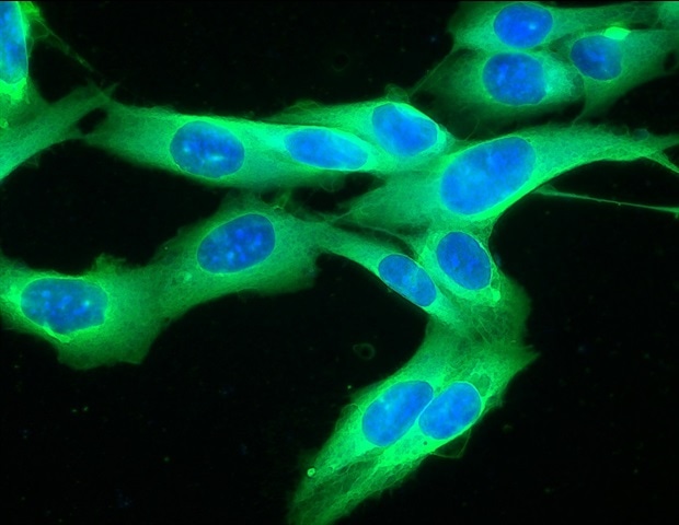 תובנות חדשות על האופן שבו תאי מלנומה מתנגדים לטיפול אימונותרפי בסרטן
