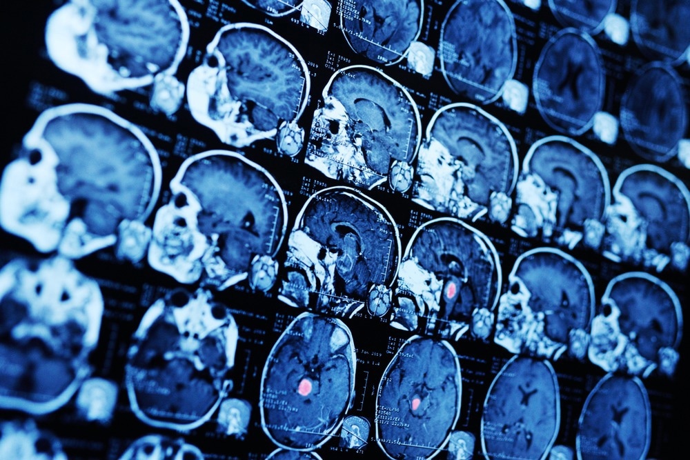 Study: Frontostriatal salience network expansion in individuals in depression. Image Credit: Evgeniy Kalinovskiy/Shutterstock.com