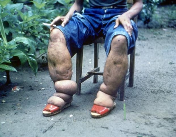 ברזיל משיגה אבן דרך בחיסול פילאריאזיס לימפתי