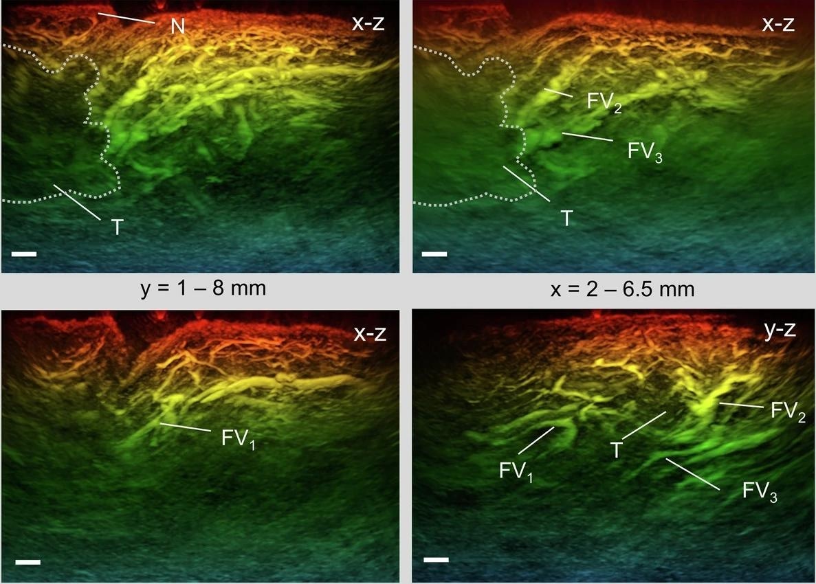Study: A fast all-optical 3D photoacoustic scanner for clinical vascular imaging