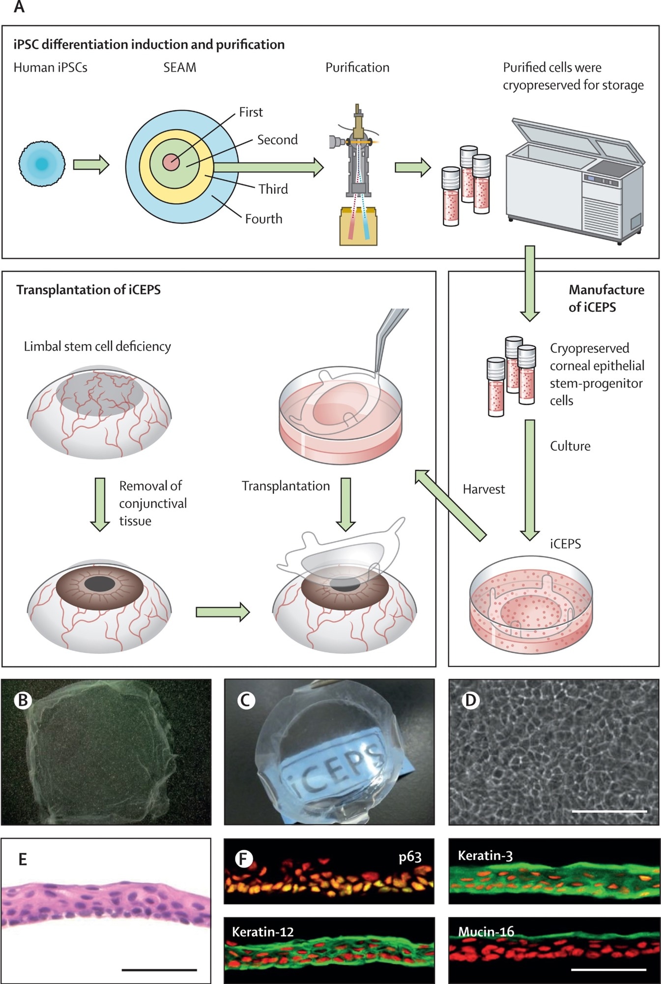 (א) סכימה של כל ההליך, החל בגידול של iPSCs אנושיים לתוך SEAMs וטיהור לאחר מכן של תאי גזע אפיתל קרנית מהאזור השלישי של SEAM באמצעות סדרן תאים. תאים אלו נשמרו לפני ייצורם ל-iCEPSs במתקן טוב לייצור גנים, תאים ומוצרים מבוססי רקמה, והשתלה לאחר מכן של iCEPS על עיניים מושפעות לאחר הסרת רקמת הלחמית בחולים עם LSCD. (ב, ג) צילומי מאקרו של iCEPS לפני ההשתלה המציגים את האופי השקוף שלהם, כאשר הטקסט 