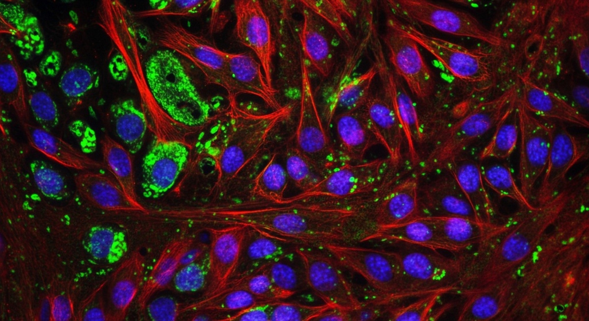 Study: Spatial transcriptomics reveals substantial heterogeneity in triple-negative breast cancer with potential clinical implications
