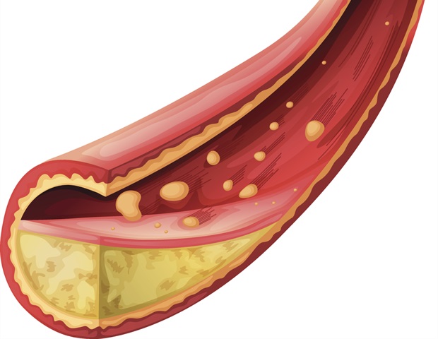 המחקר מוצא שיעורים גבוהים של מחלת עורקים היקפית לא מאובחנת ולא מטופלת