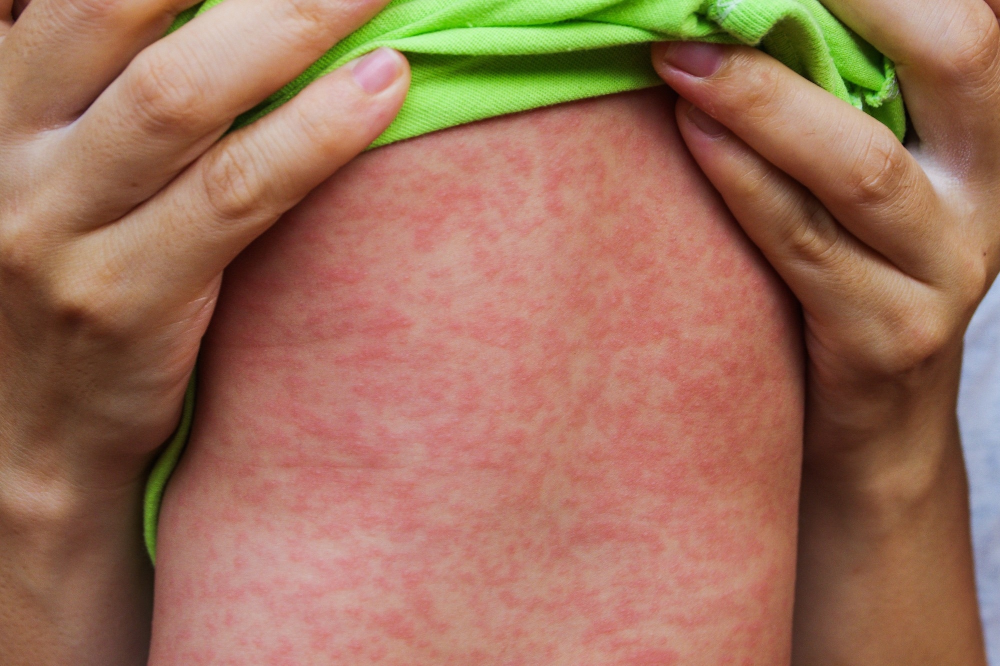 Study: Measles Vaccination Coverage and Anti-Measles Herd Immunity Levels in the World and WHO Regions Worsened from 2019 to 2023. Image Credit: Phichet Chaiyabin / Shutterstock