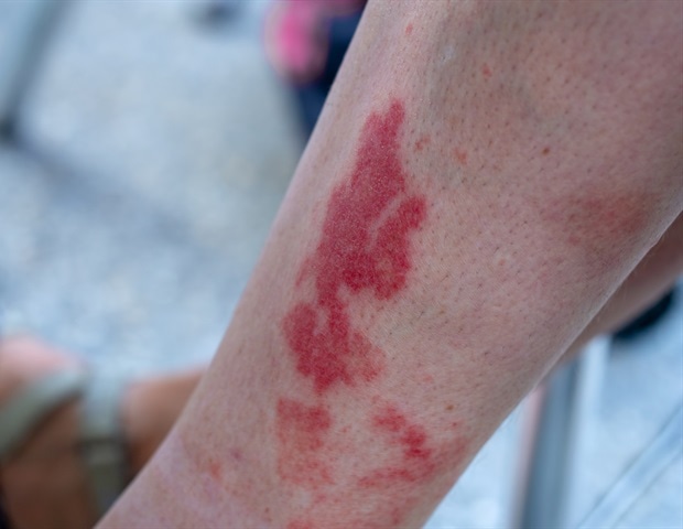 אוכלוסיות תת -אוכלוסיות נויטרופיליות יכולות לעזור לחזות הישנות מחלה אוטואימונית