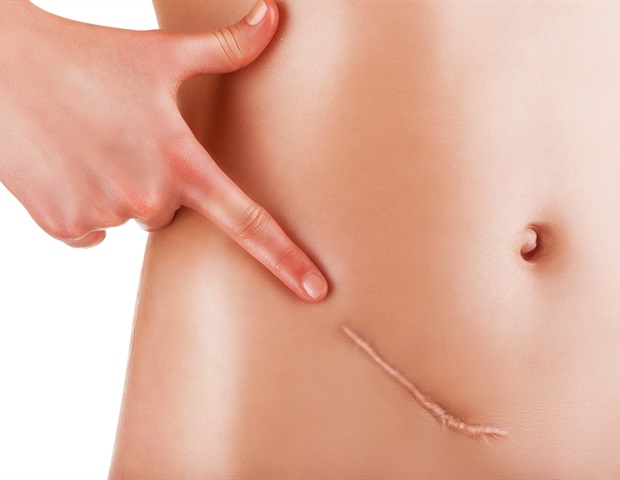 המחקר חושף את הבסיס הגנטי של סרטן שחלות נדיר ואגרסיבי