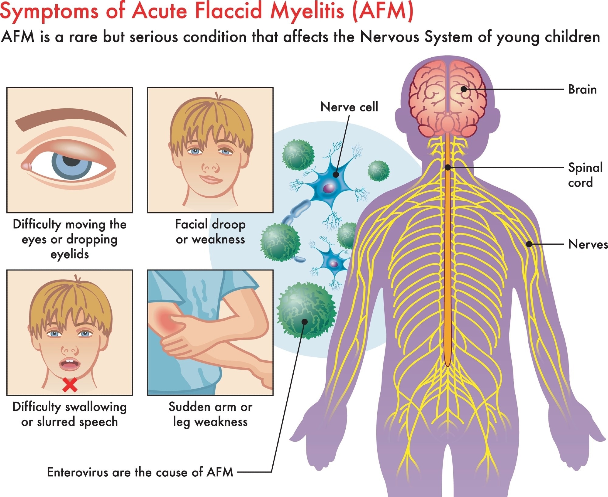 Study: Acute flaccid myelitis in Europe between 2016 and 2023: indicating the need for better registration. ​​​​​​​Image Credit: rob9000 / Shutterstock