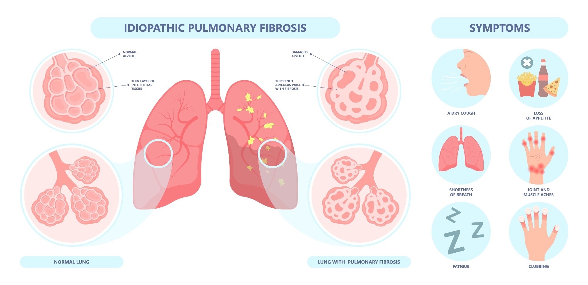 Study: A generative AI-discovered TNIK inhibitor for idiopathic pulmonary fibrosis: a randomized phase 2a trial. Image Credit: Pepermpron / Shutterstock