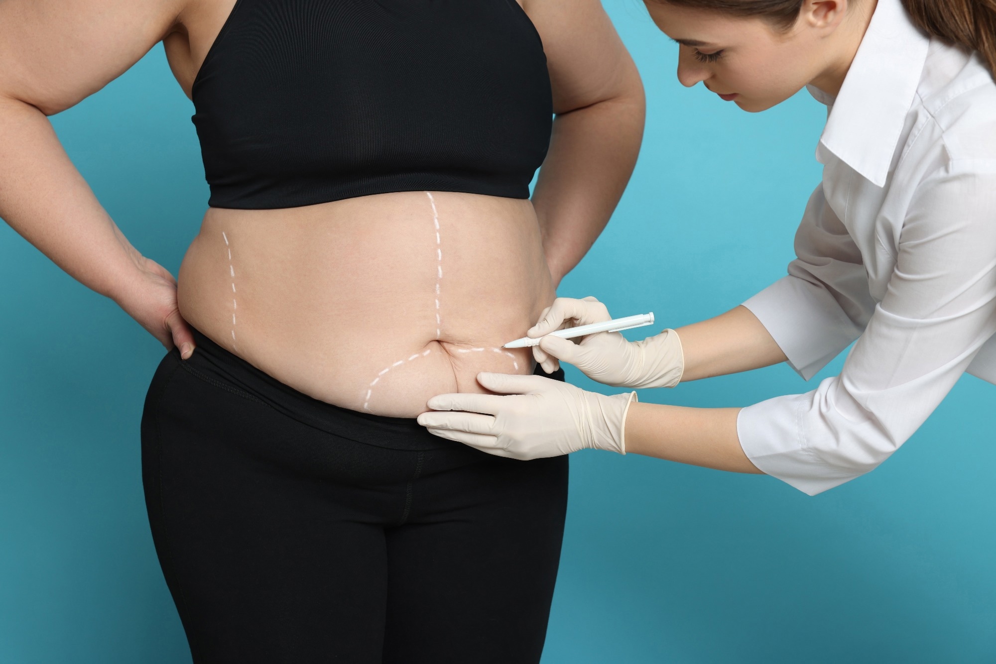 Doctor drawing marks on obese woman