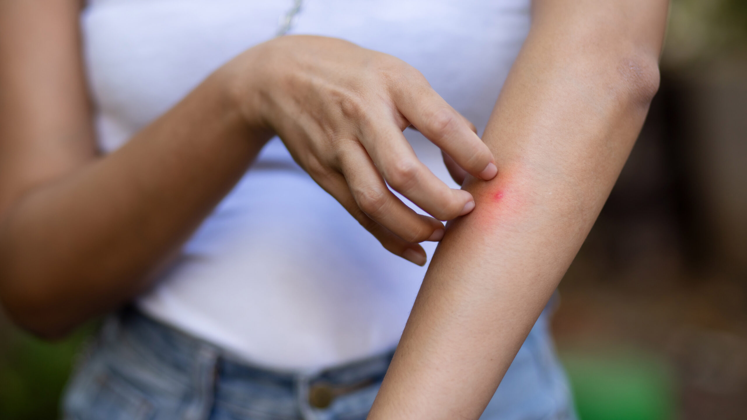 Woman scratching mosquito bite