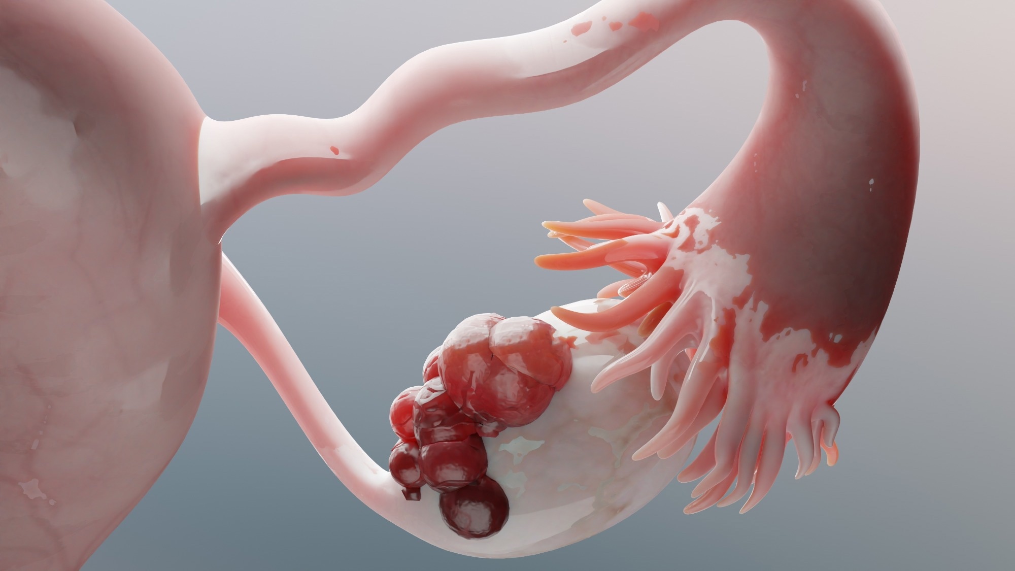 Ovarian malignant tumor