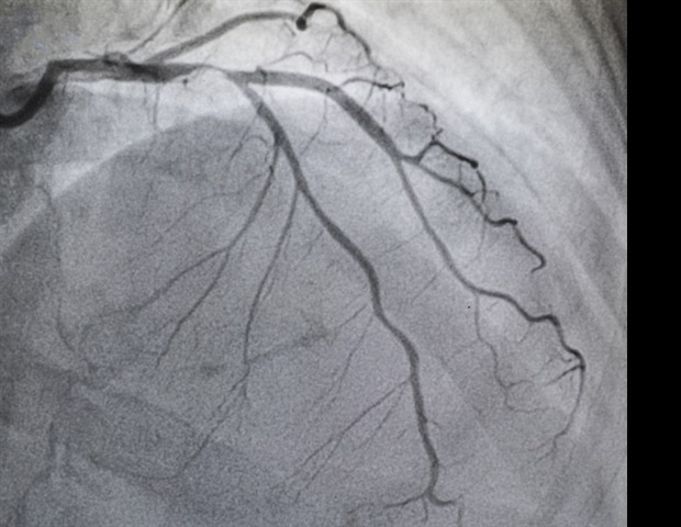 הצהרת SCAI חדשה מספקת הנחיות לסגירת PDA Transcatheter בתינוקות מוקדמים