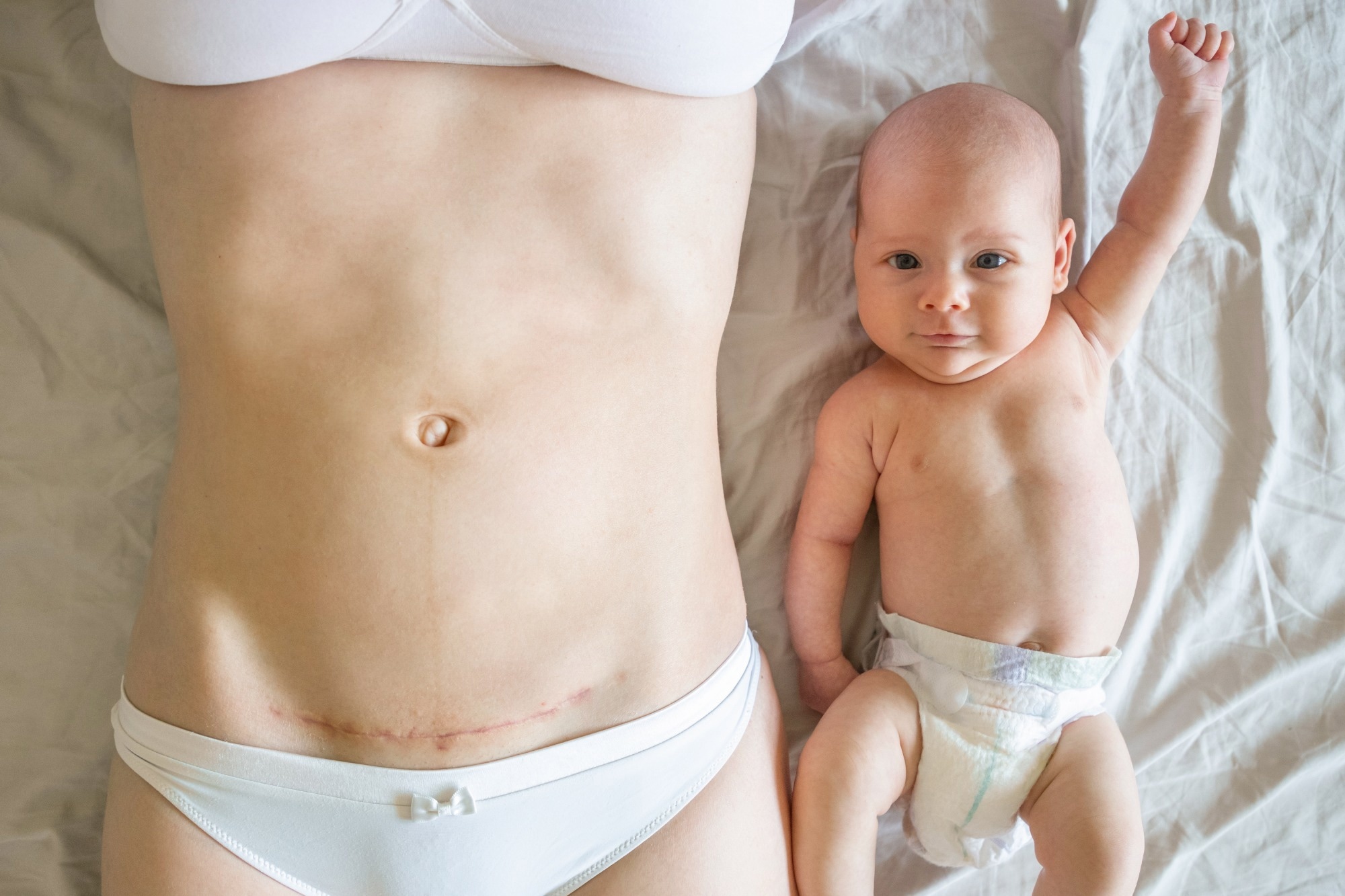 Closeup of woman belly with a scar from a cesarean section and her baby