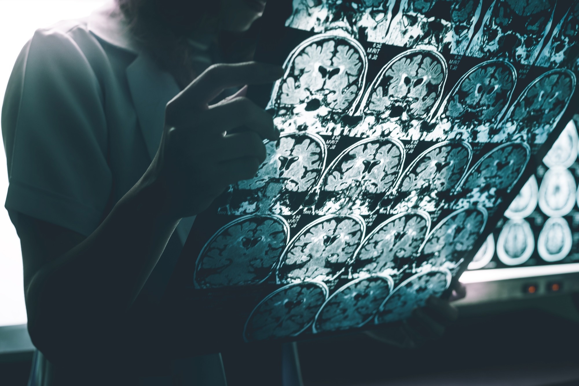 Study: Plasma Phosphorylated Tau 217 to Identify Preclinical Alzheimer Disease. Image Credit: Atthapon Raksthaput / Shutterstock