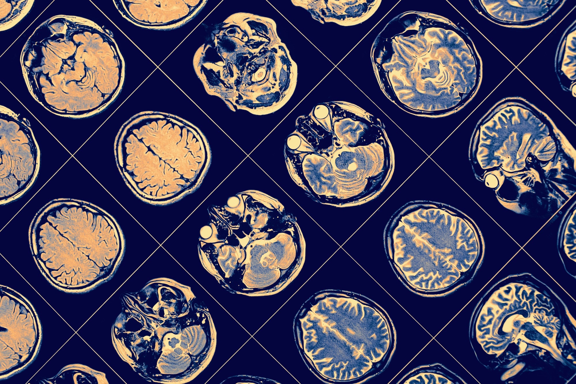 New landscape of the diagnosis of Alzheimer