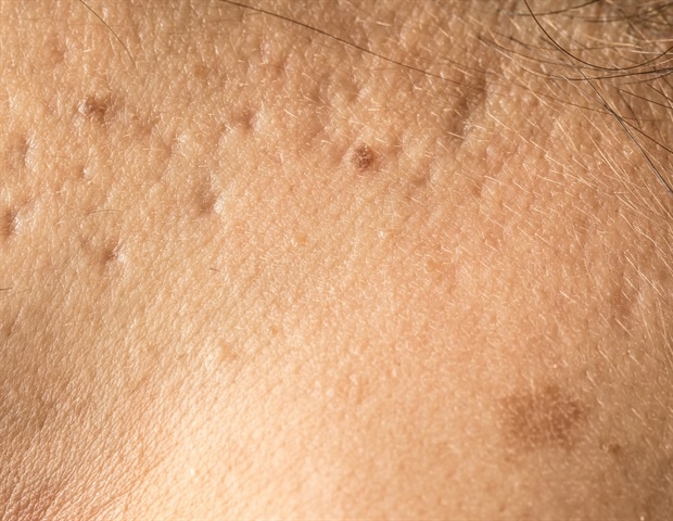 ה-FDA חולק הנחיות בטיחות לאנשים השוקלים microneedling