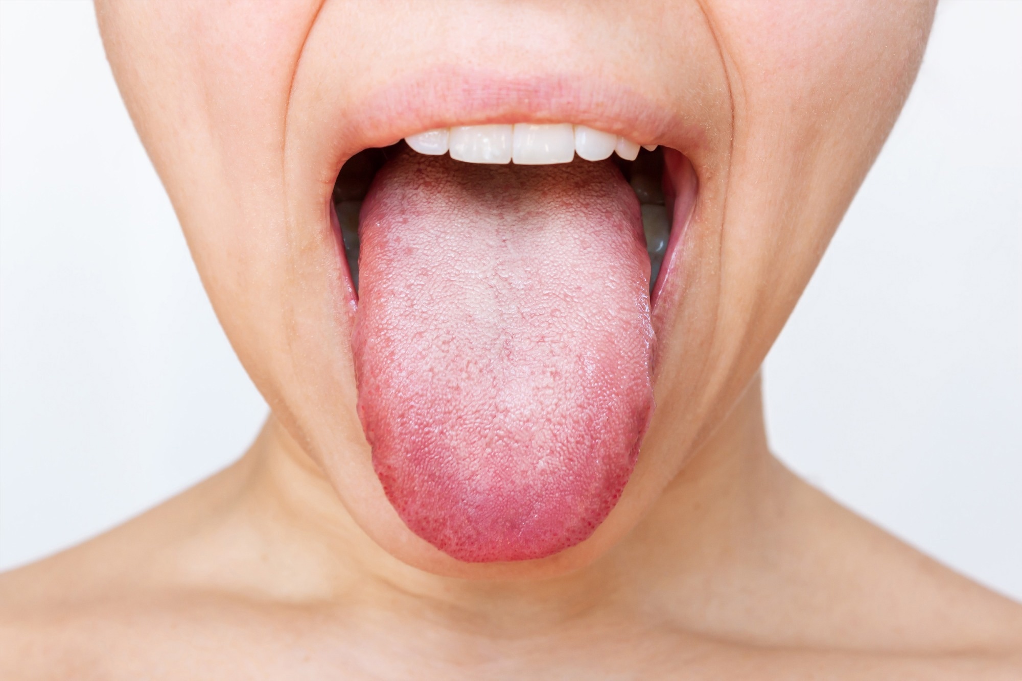 Female tongue with a white plaque
