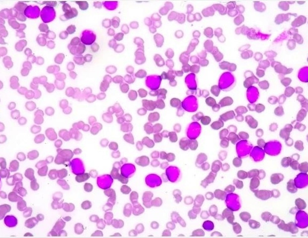 חולי אנמיה של Fanconi מראים הבדלים מטבוליים בולטים