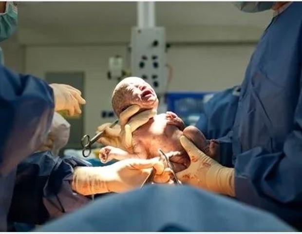 מחקר חדש תומך בהרדמה כללית כאופציה ללידות קיסריות