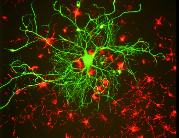 פיזיקת הפולימרים מציעה נקודות מבט חדשות על מחלות ניווניות