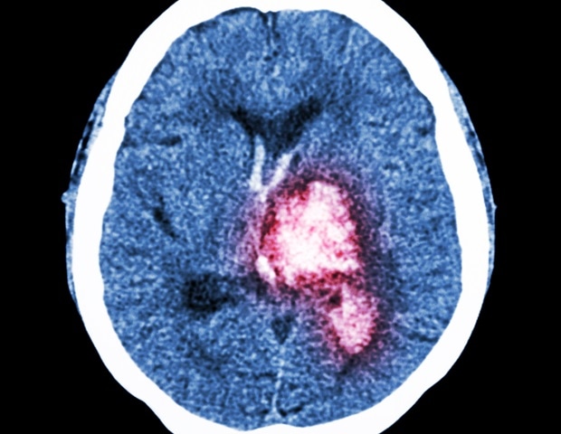 תרופה ניסויית אנגסרטיב מראה הבטחה לטיפול בהפרעת דימום תורשתית